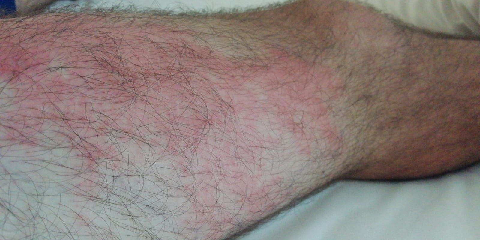 La pierna de Ángel Hidalgo tras la picadura de la avispa.
