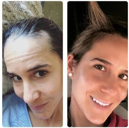 Azahara Muñoz, antes y después del tratamiento contra la enfermedad de Hashimoto.